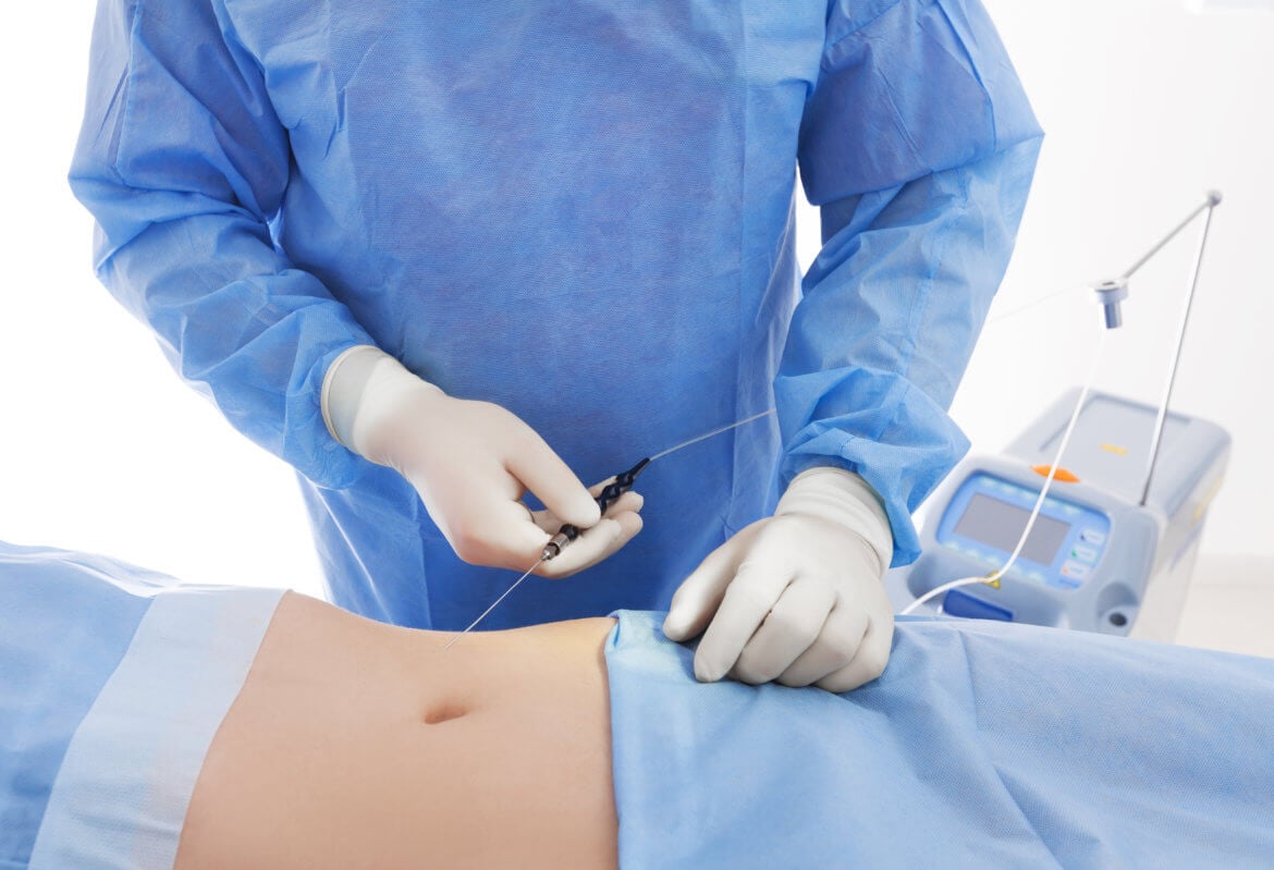 Instant Results: How Much Weight You Can Lose with Liposuction
